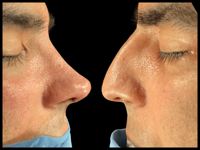 Rinoplastia antes y después, vista de perfil, paciente 01 — Blackstones Plastic Surgery, Piedras Negras