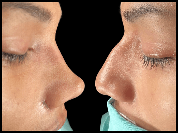 Rinoplastia antes y después, vista de perfil, paciente 02 — Blackstones Plastic Surgery, Piedras Negras