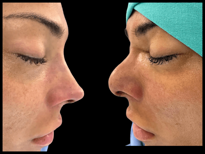 Rinoplastia antes y después, vista de perfil, paciente 03 — Blackstones Plastic Surgery, Piedras Negras