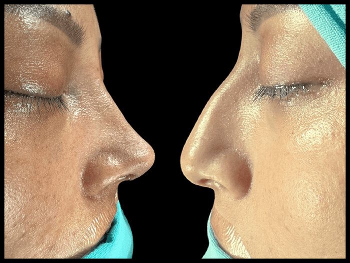 Rinoplastia antes y después, vista de perfil, paciente 04 — Blackstones Plastic Surgery, Piedras Negras