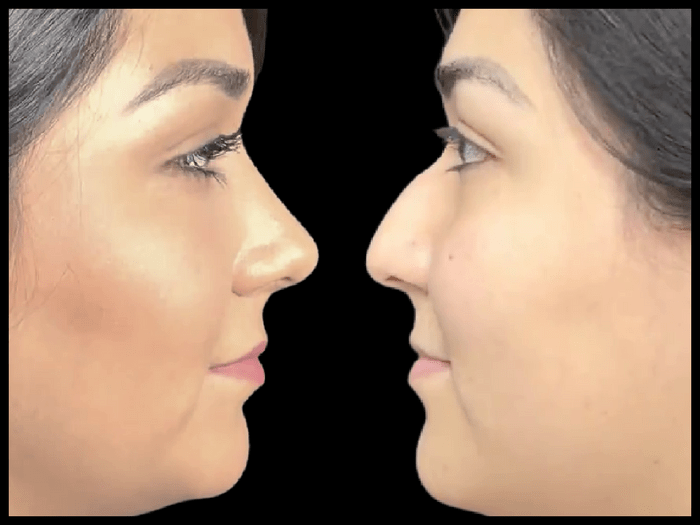 Rinoplastia antes y después, vista de perfil, paciente 05 — Blackstones Plastic Surgery, Piedras Negras