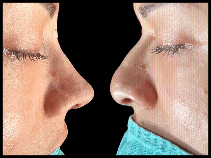 Rinoplastia antes y después, vista de perfil, paciente 06 — Blackstones Plastic Surgery, Piedras Negras