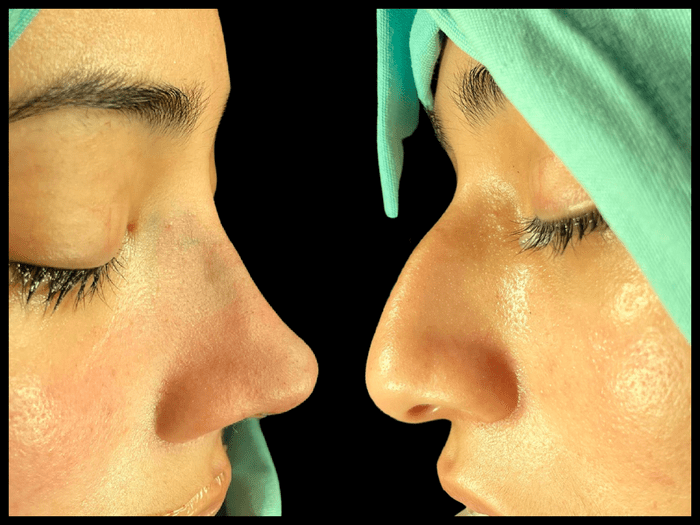 Rinoplastia antes y después, vista de perfil, paciente 07 — Blackstones Plastic Surgery, Piedras Negras