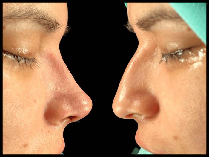 Rinoplastia antes y después, vista de perfil, paciente 08 — Blackstones Plastic Surgery, Piedras Negras