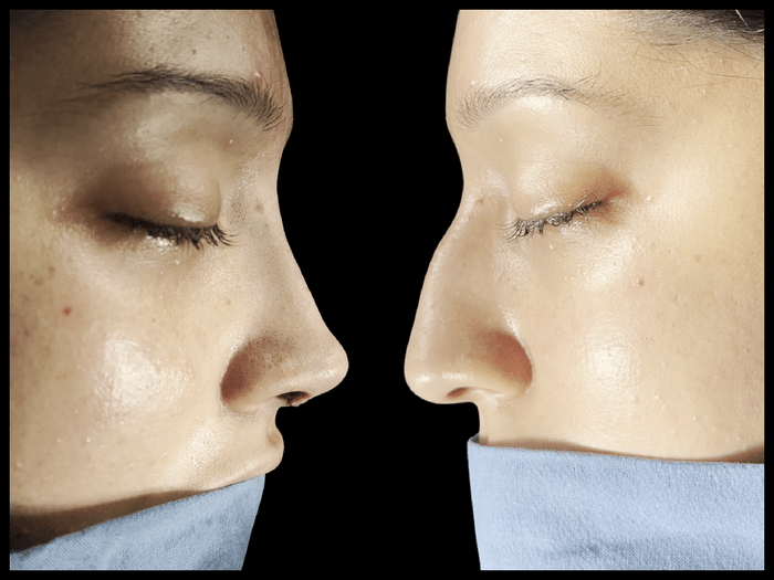 Rinoplastia antes y después, vista de perfil, paciente 09 — Blackstones Plastic Surgery, Piedras Negras
