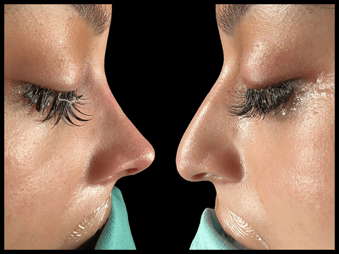 Rinoplastia antes y después, vista de perfil, paciente 10 — Blackstones Plastic Surgery, Piedras Negras
