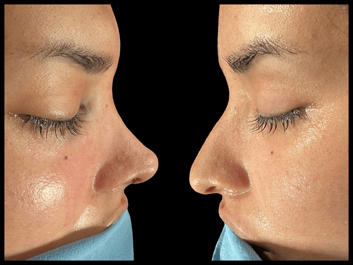 Rinoplastia antes y después, vista de perfil, paciente 11 — Blackstones Plastic Surgery, Piedras Negras