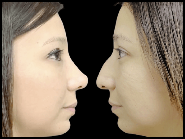 Rinoplastia antes y después, vista de perfil, paciente 12 — Blackstones Plastic Surgery, Piedras Negras